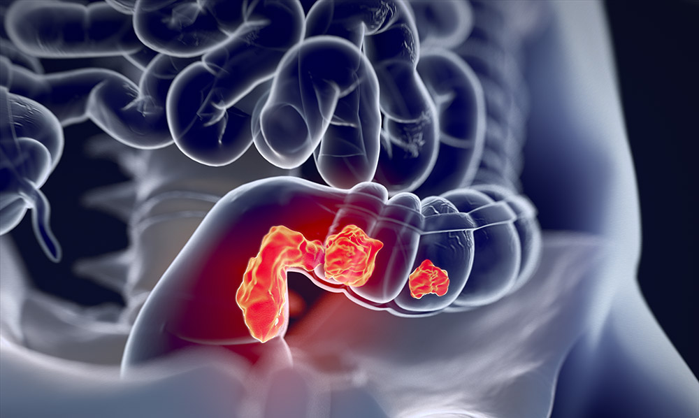 Bowel cancer: Aspirin activates protective genes.